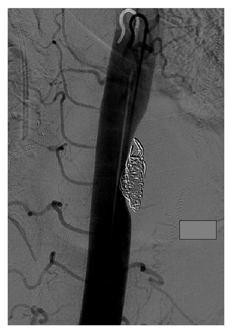 Aortogram After Coil Embolization Of The T8 Intercostal Artery Note