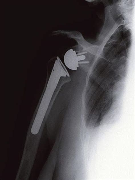 Reverse Total Shoulder Replacement Orthoinfo Aaos