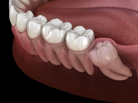 Is Wisdom Teeth Removal Painful Boston Dentist Congress Dental