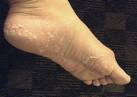 The following are the chief symptoms related to this skin condition. Jill reviews it: Baby Foot exfoliating foot peel - Jill ...