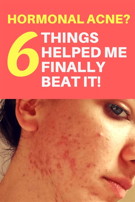 I Beat Hormonal Acne My 6 Powerful Little Secrets