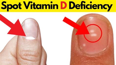 Signs And Symptoms Of Vitamin D Deficiency YouTube