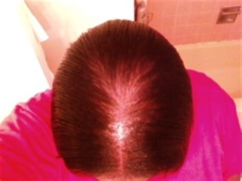(ii) treat hair loss by killing the fungus and bacteria and. PCOS, Type 2 Diabetes, Lichen Scleroses, Scaring Alopecia ...