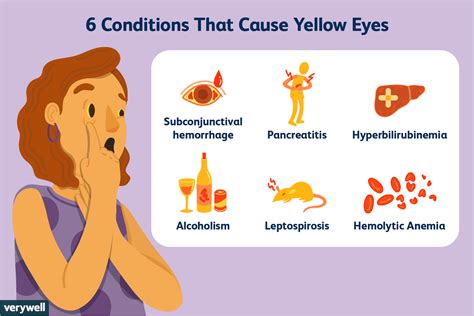 Warum Sind Deine Augen Gelb MedDe