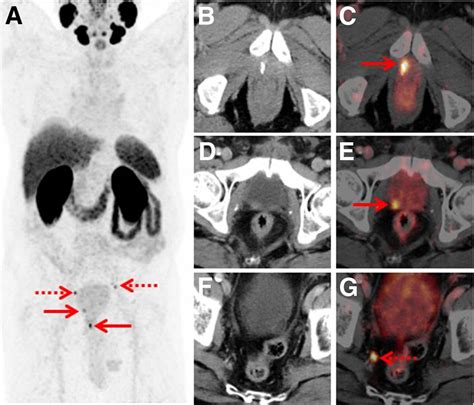 F Rhpsma Pet For The Detection Of Biochemical Recurrence Of Prostate Cancer After Radical