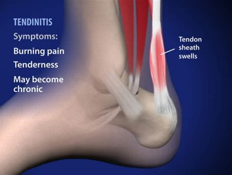 The tendon tear can be repaired, and the tendon is tubularized, restoring its normal shape. Achilles Tendonitis Pain Symptoms | Denver CO Doctors Top ...