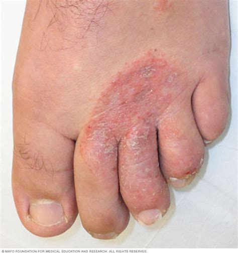 Athlete S Foot Disease Reference Guide Drugs Com