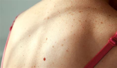 Unfortunately, every complaint or symptom of cancer can be explained by a harmless condition as well. Skin Cancer Warning Signs