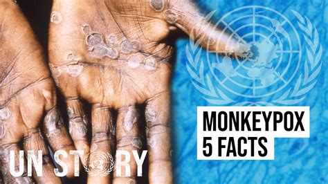 Monkeypox What You Should Know 联合国
