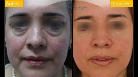 Feb 21, 2021 · diez cosméticos para tratar las ojeras, bolsas y párpados caídos una experta en dermocosmética nos explica cómo cuidar esta zona del rostro y los productos que mejor actúan en cada caso. Tratamiento para eliminar las Ojeras sin cirugía | Acido ...