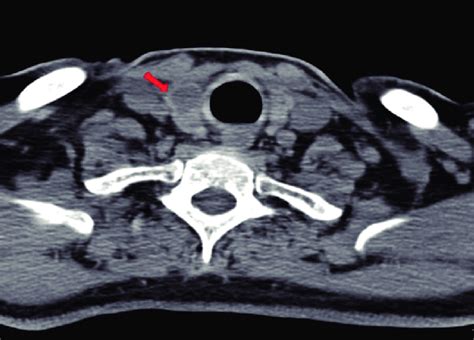 Neck Ct Showing A Hypodense Nodule Within The Right Lobe Of The Thyroid