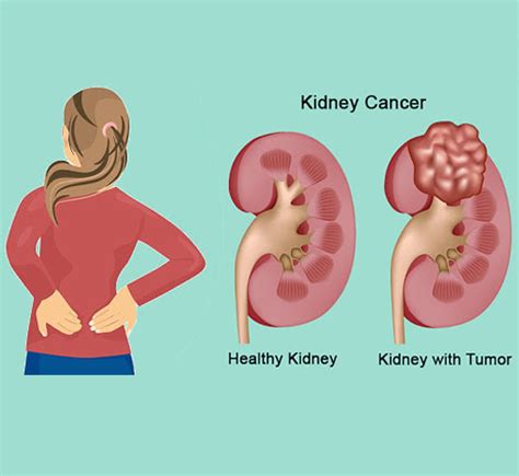 Kidney Cancer Kidney Hospital Stone Centre