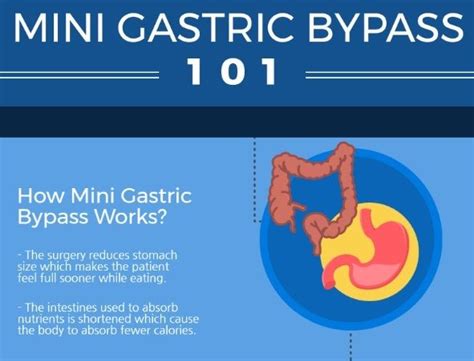 Mini Gastric Bypass 1 0 1 International Patient Facilitators