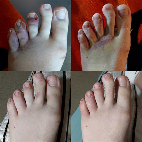 Thomas Blog Warning Gross Foot Pictures