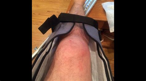How To Recover From A Broken Knee Cap YouTube
