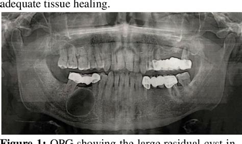 Intra Osseous Dermoid Cyst Of Mandible A Rare Case Report Kulturaupice