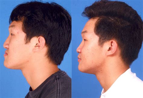 Jaw Surgery Before And After Gallery James P Bradley Md