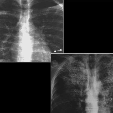 Pneumocystis Carinii Pneumonia Computed Tomography Ct In A Subacute