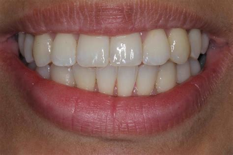 Porcelain Veneers Or Braces Make The Right Choice