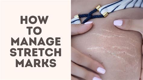 How To Manage Stretch Marks Treat Your Scars