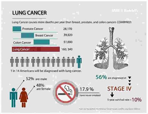 Doctors in 147 specialties are here to answer your questions or offer you advice, prescriptions, and more. Squamous Cell Lung Cancer Life Expectancy - Cancer News Update