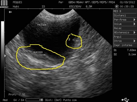 A Scottish Terrier Miraculous Recovery from Bladder Cancer ...