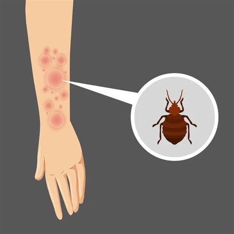 Unraveling The Mystery Behind Bed Bug Bites On Arms Causes Symptoms And Treatment