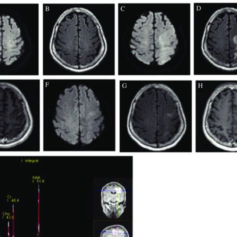 Findings Of Brain Mri And Mrs In Case 3 A And B Pod 1 Mri Shows A
