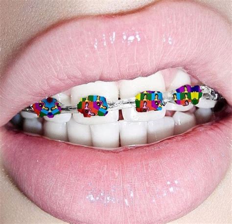 Diy Braces Dental Braces Teeth Braces Dental Care Fake Braces Silver Braces Braces Tips