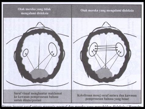 Image via facebook kami peduli anak disleksia. Disini mulanya...: KBK3073 - DISLEKSIA