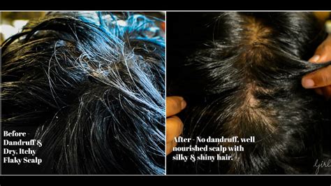 Magical Hair Mask For Dry Itchy And Dandruff Prone Hair Get Best Results In One Wash Youtube