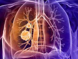 How to spot lung cancer early | cancer research uk. Single molecule determines lung cancer cell death