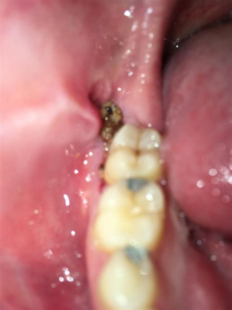 Look This Hole Where Wisdom Tooth Was 4 Tooth Bantuanbpjs