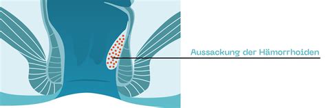 Um es von anderen krankheitsbildern abgrenzen zu können, handelt es sich hier um hellrotes blut, was gleichzeitig darauf hinweist, dass es sich um blut aus den arteriellen gefäßen handelt. Hämorrhoiden Symptome & Behandlung │ ProctyClean®