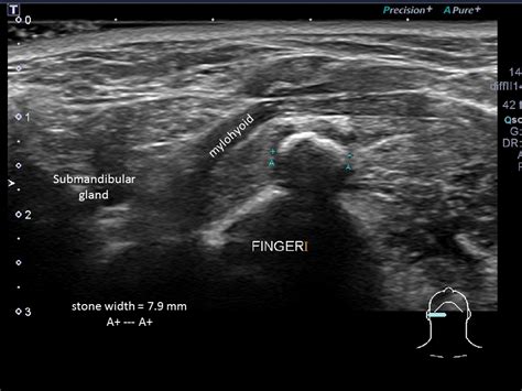 Submandibular Gland Stone Ultrasound