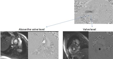 Mri Evaluation In Patients With Prosthetic Valves