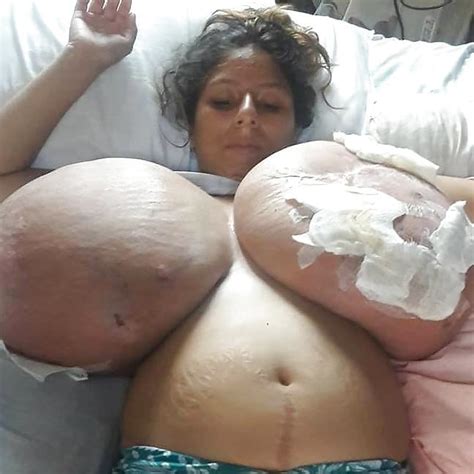Massive Tits Breast Reduction Pics Xhamster