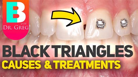 Tooth Gaps Black Triangles With Braces Or Invisalign Youtube