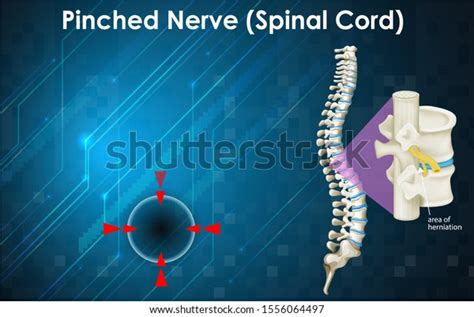Diagram Showing Pinched Nerve Illustration Stock Vector Royalty Free