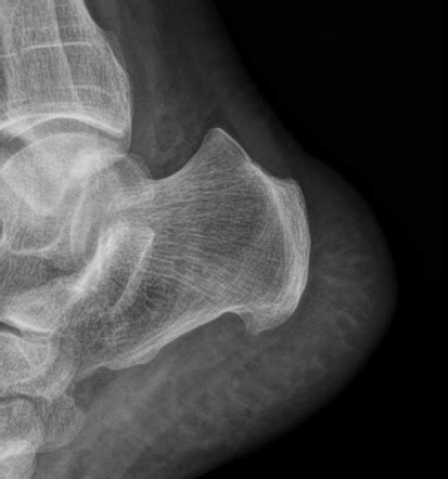 Haglund Deformity Radiology Reference Article Radiopaedia Org