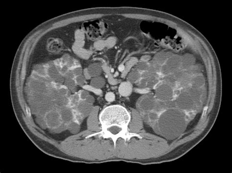 Computed Tomography Evaluation Of Autosomal Dominant Polycystic Kidney