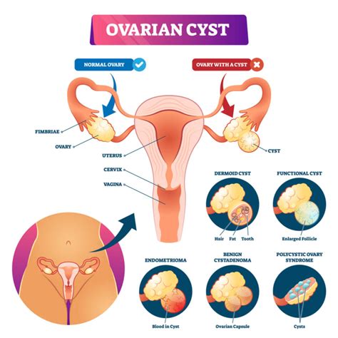 ovarian cysts what are they and what are the treatment options