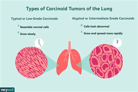 Carcinoid Tumors Of The Lung Overview And More