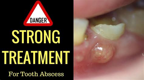 Awasome How To Drain A Gum Abscess At Home Reddit References Organical