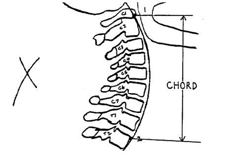 Chiropractic And Spinal Alignment And Cervical Curve Kelly