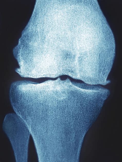 What Is An Osteophyte Bone Spur