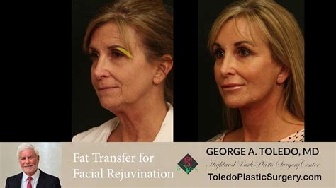 Facial Rejuvenation With Dermal Fat Grafting And Fat Injections Youtube