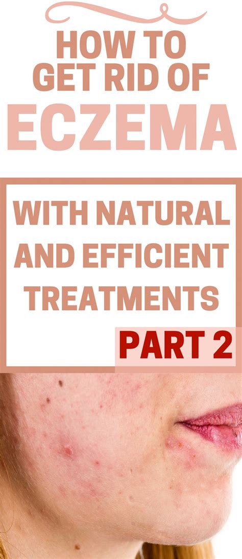 How To Get Rid Of Eczema With Natural And Efficient Treatments Part 2