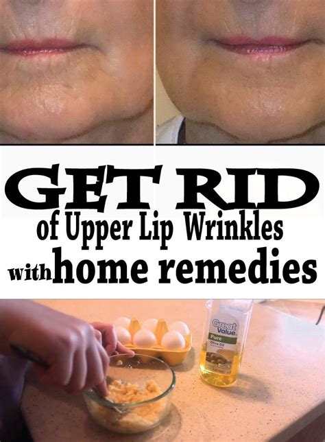 Get Rid Of Upper Lip Wrinkles With Home Remedies Lip Wrinkles Upper