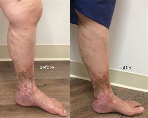 Before And After East Bay Vein Specialists